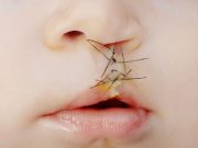 New Classification System Accurate for Nasal Deformities in Cleft Lip and Palate