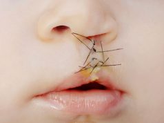 New Classification System Accurate for Nasal Deformities in Cleft Lip and Palate