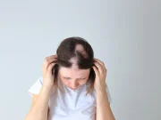 Alopecia Areata Associated With Severe Psychosocial Impact