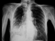 Arizona Resident Dies From Pneumonic Plague