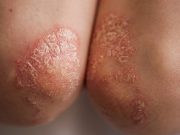 Subclinical Synovitis Risk Higher in Psoriasis Without Musculoskeletal Involvement