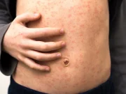 Measles Outbreak in Texas Is Over After Hundreds Infected and 2 Deaths