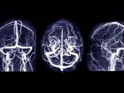 Prenatal Exposure to Pesticide Chlorpyrifos Linked to Brain Abnormalities