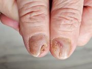 N-NAIL Score More Accurate Than NAPSI for Diagnosing Nail Psoriasis