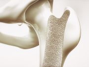 Skipping Breakfast, Eating Late May Increase Osteoporosis Risk