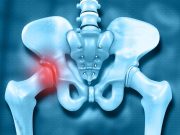 Most Adults Miss Symptoms of Hip Problems