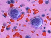 Leukemia Stem Cell-Based Method Aids Relapse Prediction in Acute Myeloid Leukemia