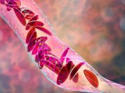 Exa-Cel Gene Therapy Improves Quality of Life in Severe Sickle Cell Disease