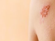 Two-Dose Recombinant Zoster Vaccine Effective in Older Adults, Regardless of Prior Vaccination