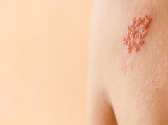 Two-Dose Recombinant Zoster Vaccine Effective in Older Adults, Regardless of Prior Vaccination