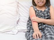 FDA Approves Opzelura for Atopic Dermatitis in Children