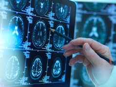 Subthalamic Deep Brain Stimulation Effective Long-Term for Parkinson Disease