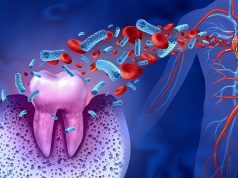 Periodontal Disease, Caries Linked to Risk for Ischemic Stroke, MACE