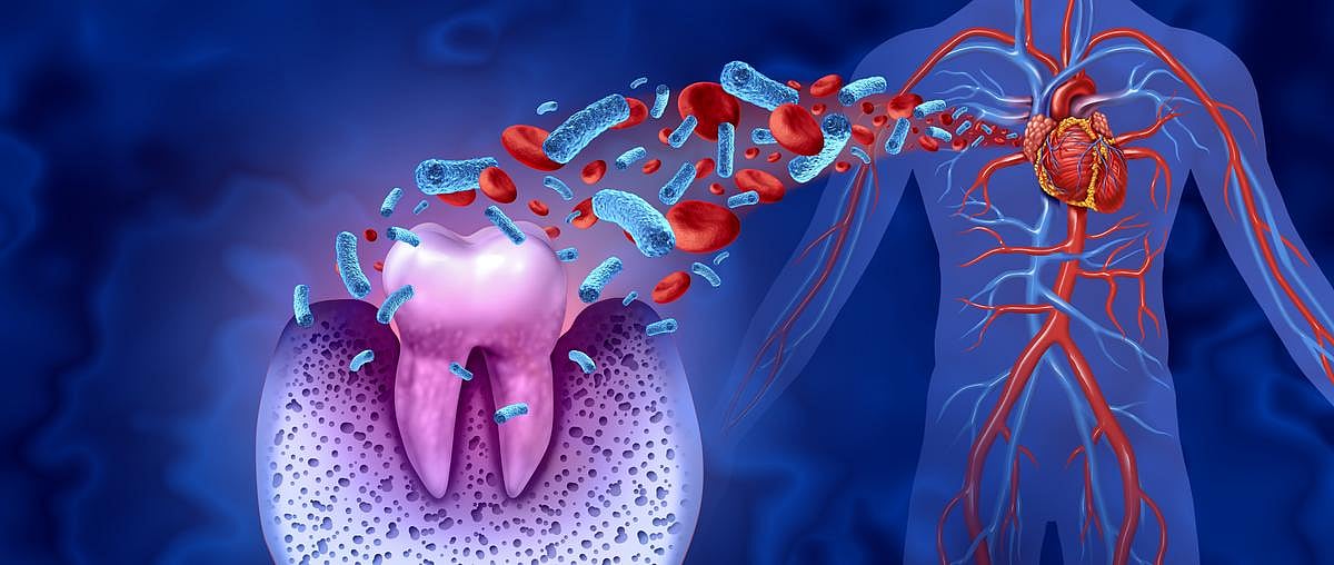 Periodontal Disease