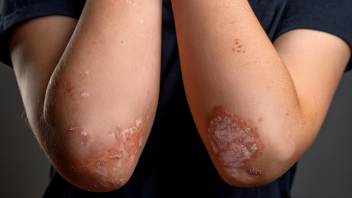 Early Change in Family Structure May Increase Risk for Psoriasis