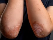 FDA Approves Tremfya for Pediatric Plaque Psoriasis, Active Psoriatic Arthritis