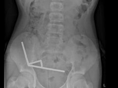 Teen Loses Part of Bowel After Swallowing 80+ Magnets
