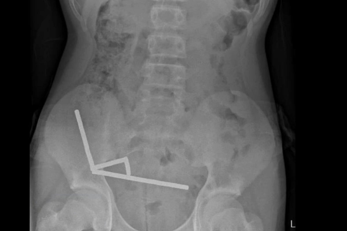Teen Loses Part of Bowel After Swallowing 80+ Magnets