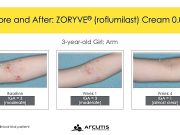 FDA Approves Zoryve for Atopic Dermatitis in Young Children