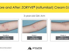 FDA Approves Zoryve for Atopic Dermatitis in Young Children