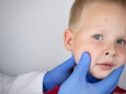 ACAAI: Eczema Onset, Severity Can Effect Child’s Ability to Outgrow Food Allergy