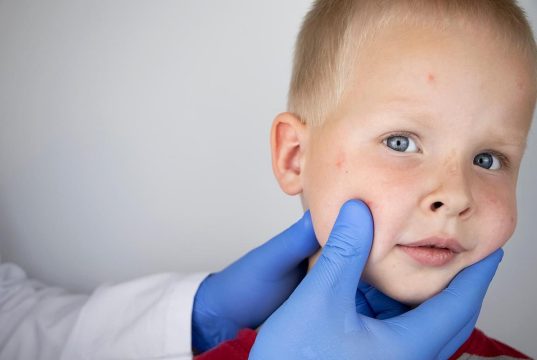 ACAAI: Eczema Onset, Severity Can Effect Child’s Ability to Outgrow Food Allergy