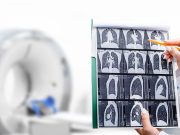 Direct-to-Patient Digital Health Program Improves Lung Cancer Screening Rates