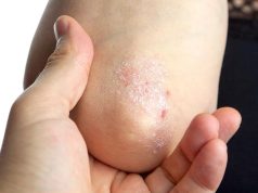 Icotrokinra Beneficial for Adults, Teens With Plaque Psoriasis