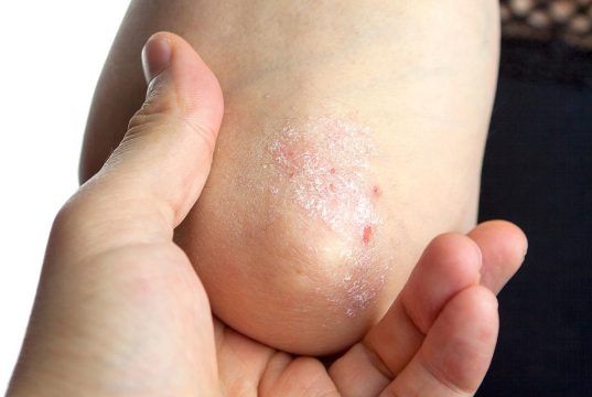 Icotrokinra Beneficial for Adults, Teens With Plaque Psoriasis