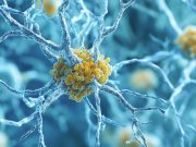 MCI, Dementia Risks Up With Increasing Biological Severity of Alzheimer Disease