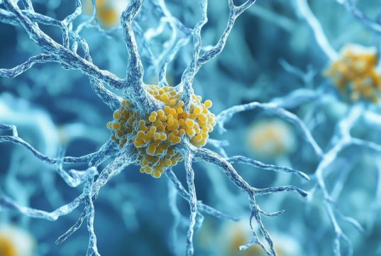 MCI, Dementia Risks Up With Increasing Biological Severity of Alzheimer Disease