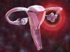 Four Subtypes of Polycystic Ovary Syndrome Identified