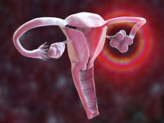 Four Subtypes of Polycystic Ovary Syndrome Identified