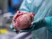 Could Pig Kidneys End the Transplant Shortage? First U.S. Trial Begins
